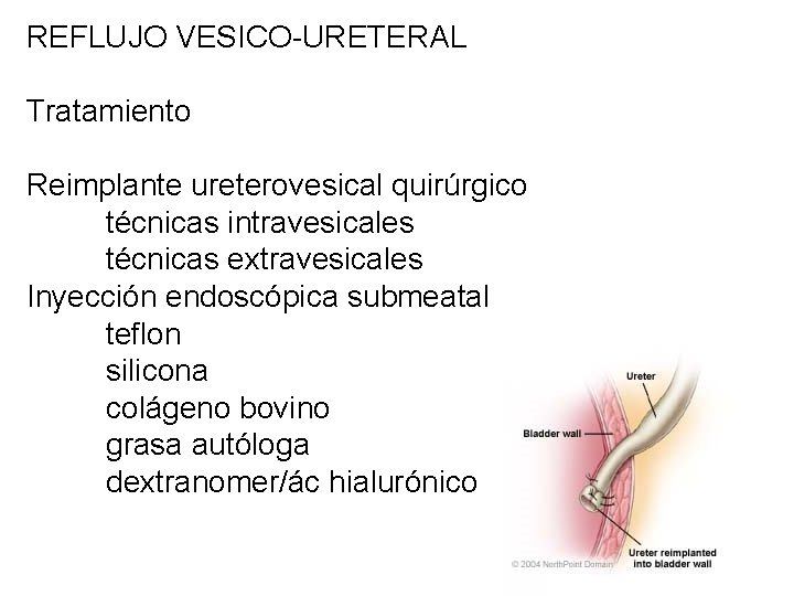 REFLUJO VESICO-URETERAL Tratamiento Reimplante ureterovesical quirúrgico técnicas intravesicales técnicas extravesicales Inyección endoscópica submeatal teflon