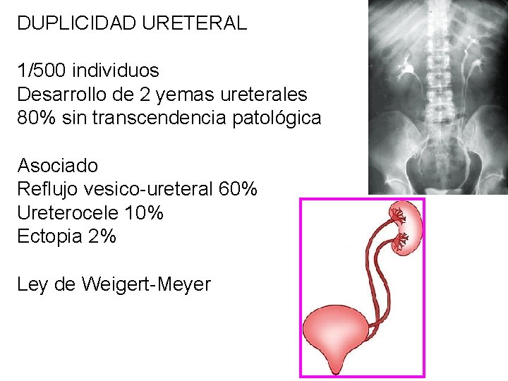 DUPLICIDAD URETERAL 1/500 individuos Desarrollo de 2 yemas ureterales 80% sin transcendencia patológica Asociado