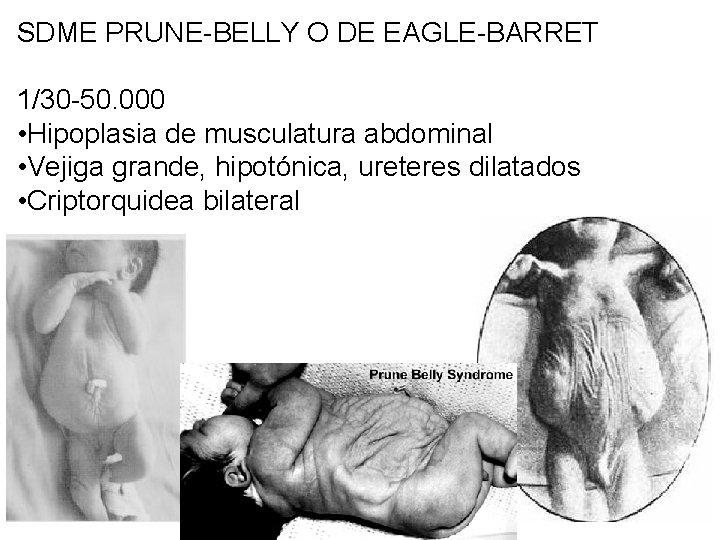 SDME PRUNE-BELLY O DE EAGLE-BARRET 1/30 -50. 000 • Hipoplasia de musculatura abdominal •