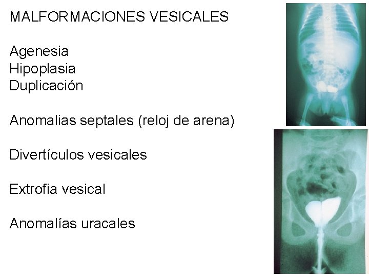 MALFORMACIONES VESICALES Agenesia Hipoplasia Duplicación Anomalias septales (reloj de arena) Divertículos vesicales Extrofia vesical