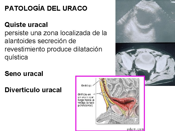 PATOLOGÍA DEL URACO Quiste uracal persiste una zona localizada de la alantoides secreción de