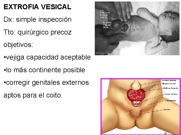 EXTROFIA VESICAL Dx: simple inspección Tto: quirúrgico precoz objetivos: • vejiga capacidad aceptable •