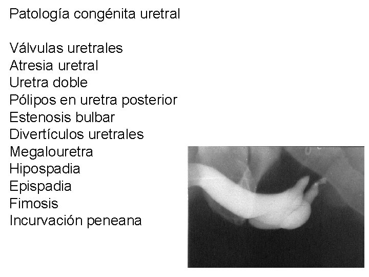 Patología congénita uretral Válvulas uretrales Atresia uretral Uretra doble Pólipos en uretra posterior Estenosis
