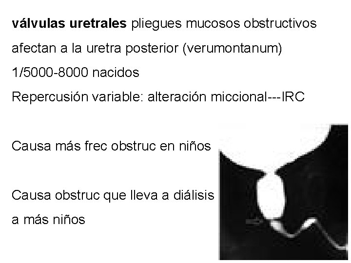 válvulas uretrales pliegues mucosos obstructivos afectan a la uretra posterior (verumontanum) 1/5000 -8000 nacidos