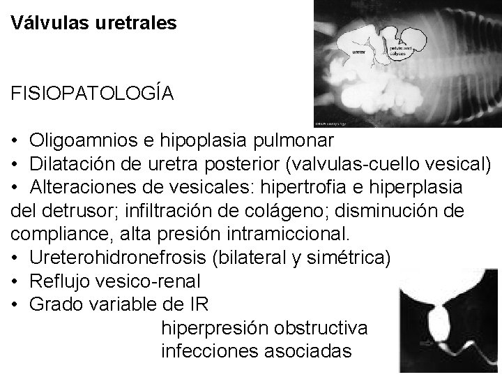 Válvulas uretrales FISIOPATOLOGÍA • Oligoamnios e hipoplasia pulmonar • Dilatación de uretra posterior (valvulas-cuello