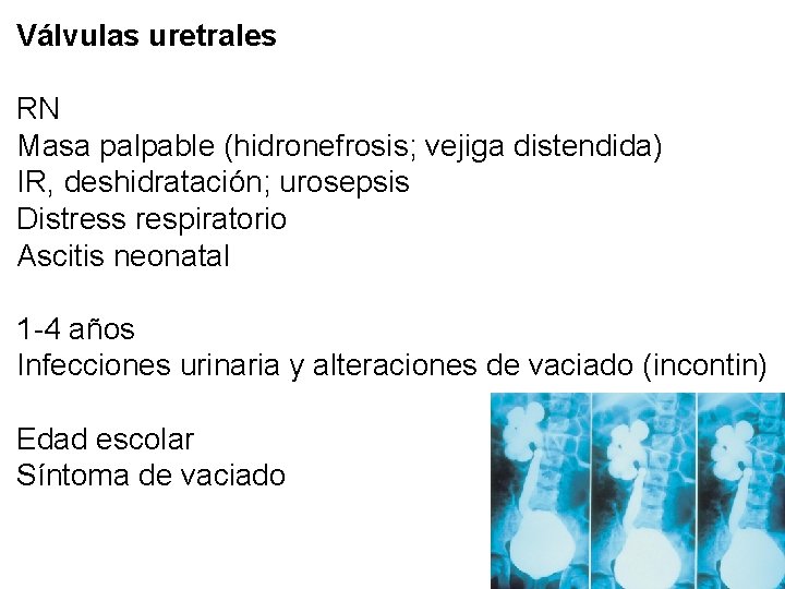 Válvulas uretrales RN Masa palpable (hidronefrosis; vejiga distendida) IR, deshidratación; urosepsis Distress respiratorio Ascitis