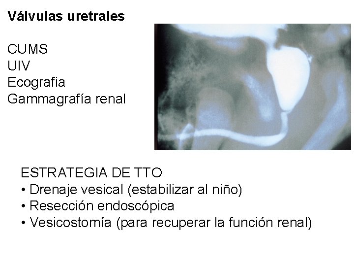 Válvulas uretrales CUMS UIV Ecografia Gammagrafía renal ESTRATEGIA DE TTO • Drenaje vesical (estabilizar