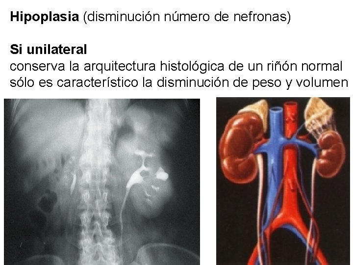 Hipoplasia (disminución número de nefronas) Si unilateral conserva la arquitectura histológica de un riñón