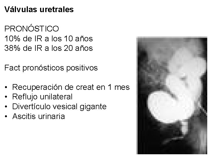 Válvulas uretrales PRONÓSTICO 10% de IR a los 10 años 38% de IR a