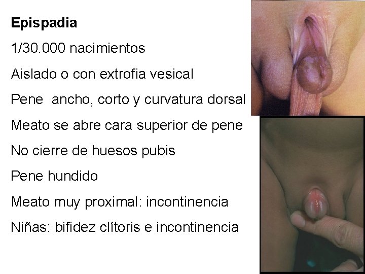 Epispadia 1/30. 000 nacimientos Aislado o con extrofia vesical Pene ancho, corto y curvatura