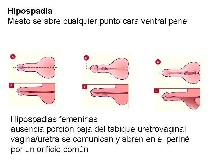 Hipospadia Meato se abre cualquier punto cara ventral pene Hipospadias femeninas ausencia porción baja