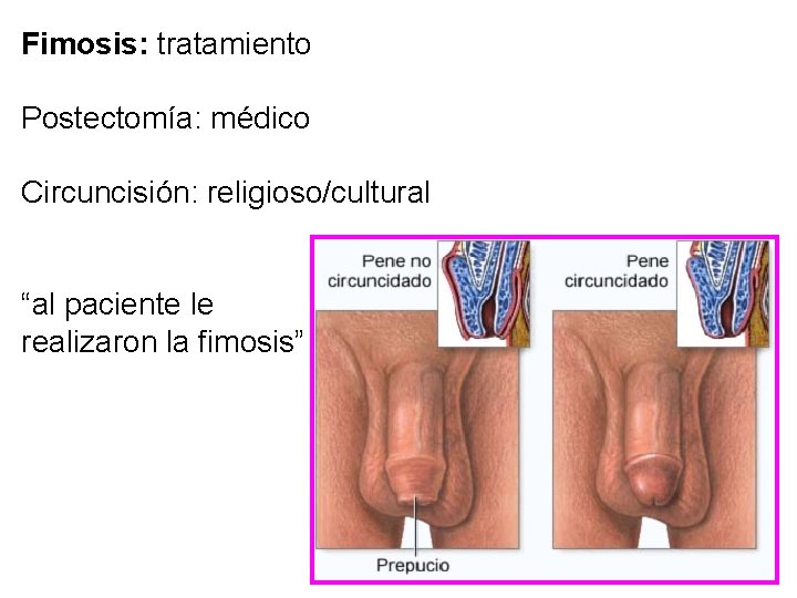 Fimosis: tratamiento Postectomía: médico Circuncisión: religioso/cultural “al paciente le realizaron la fimosis” 