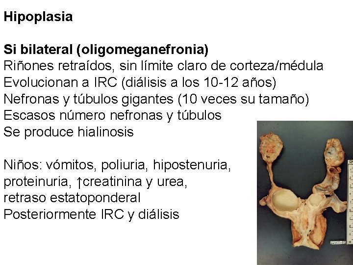 Hipoplasia Si bilateral (oligomeganefronia) Riñones retraídos, sin límite claro de corteza/médula Evolucionan a IRC