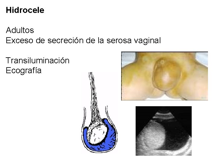 Hidrocele Adultos Exceso de secreción de la serosa vaginal Transiluminación Ecografía 