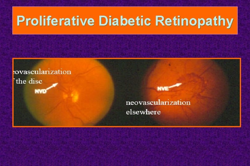 Proliferative Diabetic Retinopathy 