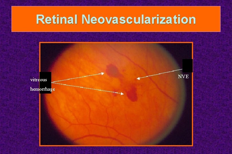 Retinal Neovascularization vitreous hemorrhage NVE 