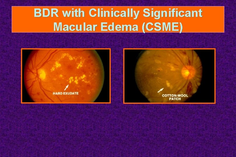BDR with Clinically Significant Macular Edema (CSME) 
