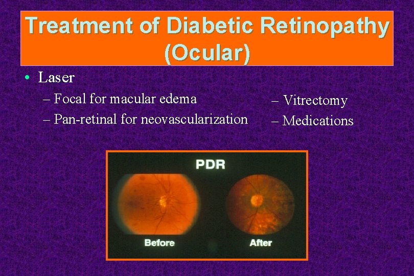 Treatment of Diabetic Retinopathy (Ocular) • Laser – Focal for macular edema – Pan-retinal