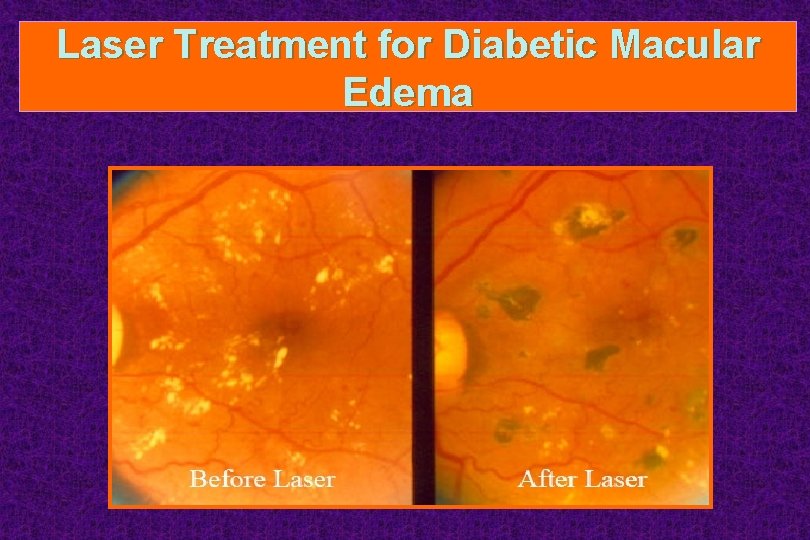 Laser Treatment for Diabetic Macular Edema 