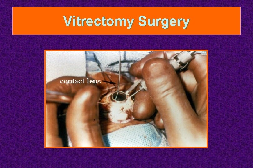Vitrectomy Surgery 