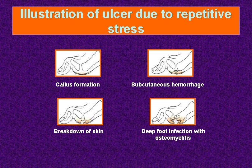Illustration of ulcer due to repetitive stress Callus formation Breakdown of skin Subcutaneous hemorrhage