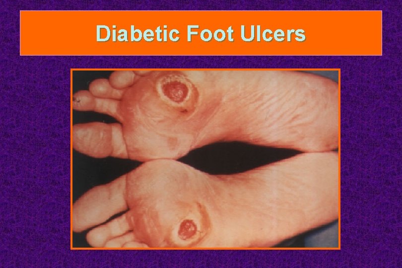 Diabetic Foot Ulcers 