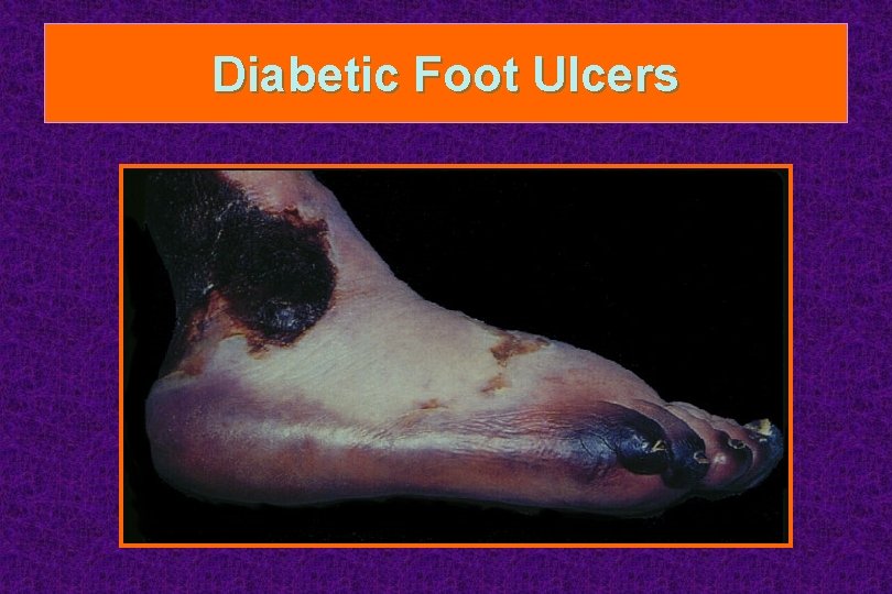 Diabetic Foot Ulcers 