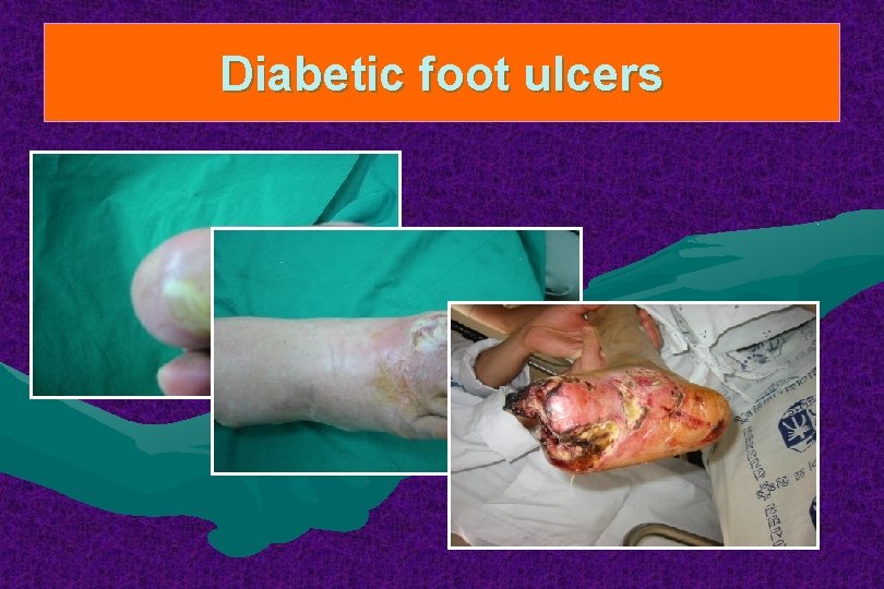 Diabetic foot ulcers 