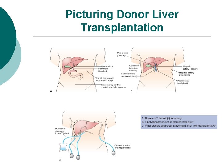 Picturing Donor Liver Transplantation 
