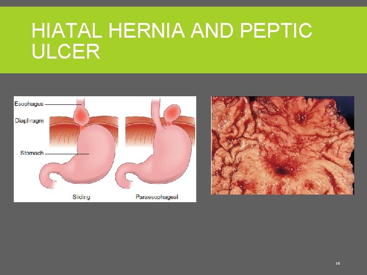 HIATAL HERNIA AND PEPTIC ULCER From Frazier MS: Essentials of human diseases and conditions,