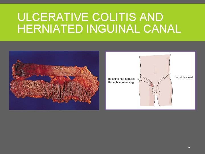 ULCERATIVE COLITIS AND HERNIATED INGUINAL CANAL From Hagen-Ansert SL: Textbook of diagnostic sonography, ed