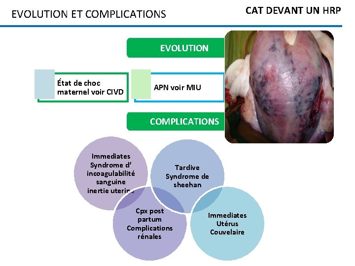 CAT DEVANT UN HRP EVOLUTION ET COMPLICATIONS EVOLUTION État de choc maternel voir CIVD