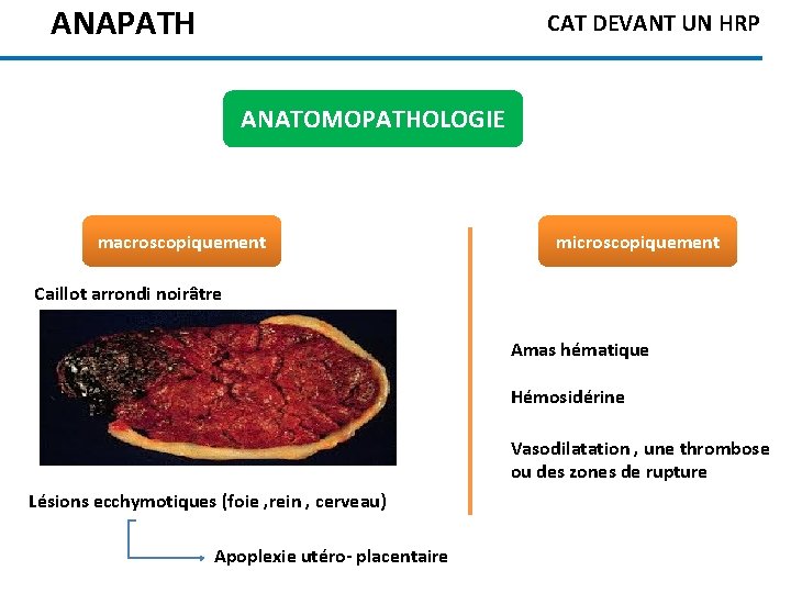 ANAPATH CAT DEVANT UN HRP ANATOMOPATHOLOGIE macroscopiquement microscopiquement Caillot arrondi noirâtre Amas hématique Hémosidérine