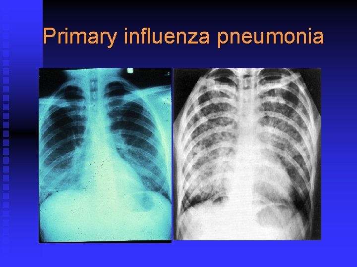 Primary influenza pneumonia 