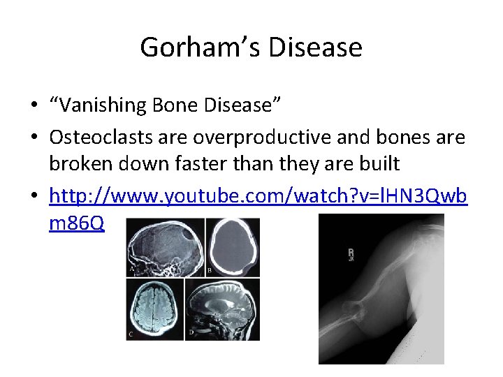 Gorham’s Disease • “Vanishing Bone Disease” • Osteoclasts are overproductive and bones are broken