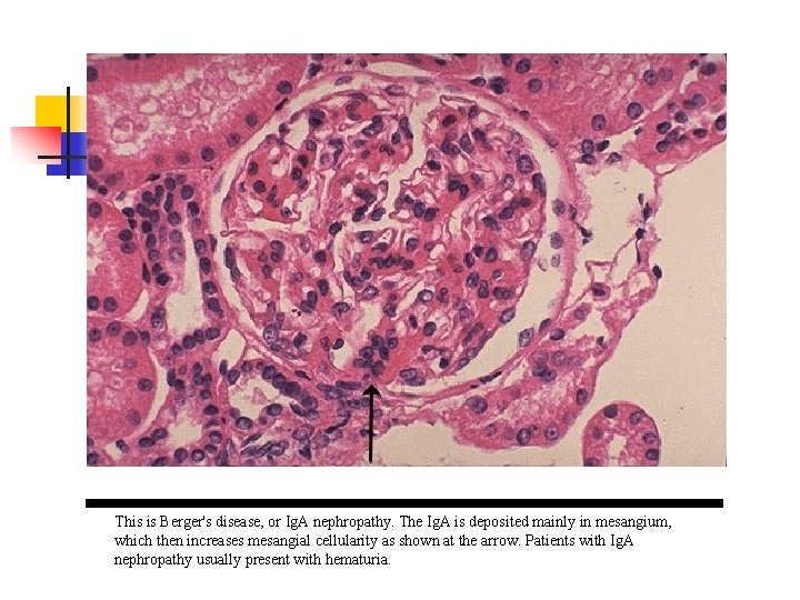 This is Berger's disease, or Ig. A nephropathy. The Ig. A is deposited mainly