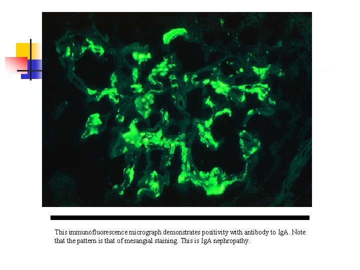 This immunofluorescence micrograph demonstrates positivity with antibody to Ig. A. Note that the pattern