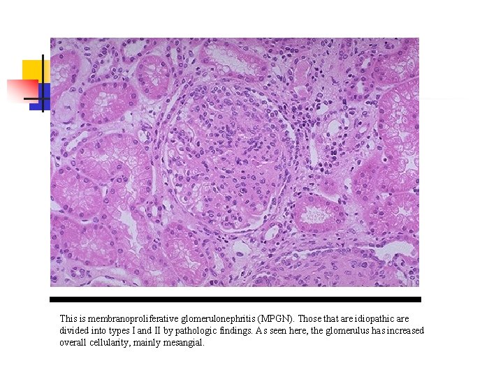This is membranoproliferative glomerulonephritis (MPGN). Those that are idiopathic are divided into types I