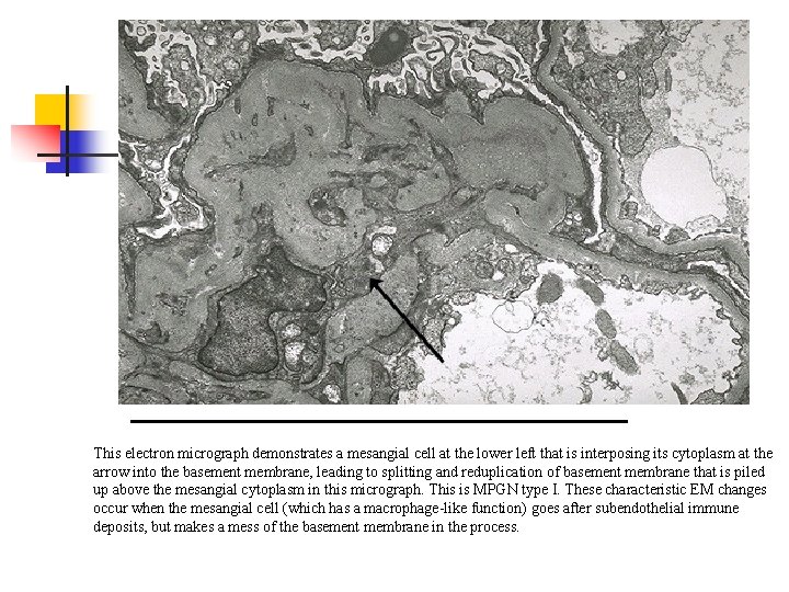 This electron micrograph demonstrates a mesangial cell at the lower left that is interposing