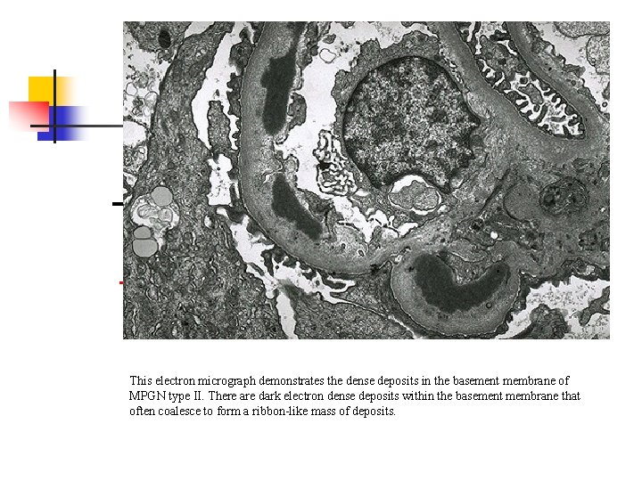 This electron micrograph demonstrates the dense deposits in the basement membrane of MPGN type