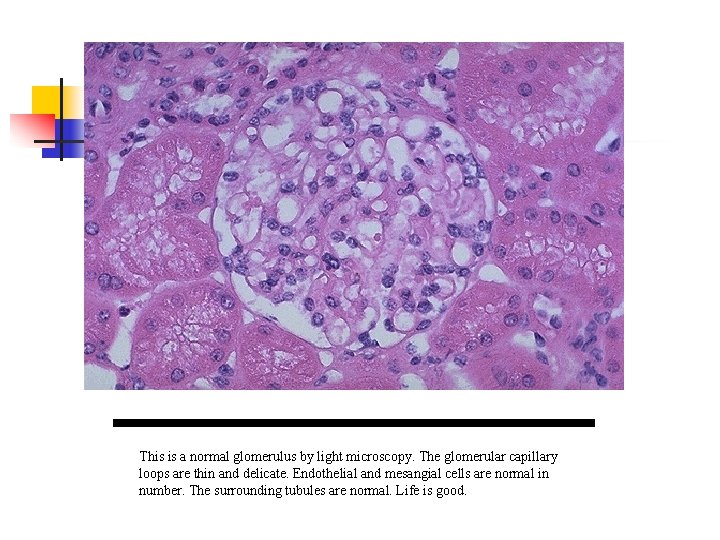 This is a normal glomerulus by light microscopy. The glomerular capillary loops are thin
