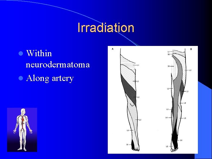 Irradiation l Within neurodermatoma l Along artery 