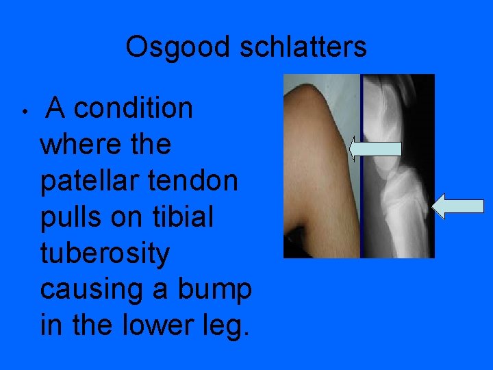 Osgood schlatters • A condition where the patellar tendon pulls on tibial tuberosity causing
