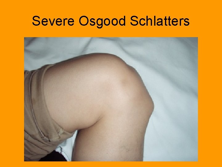Severe Osgood Schlatters 