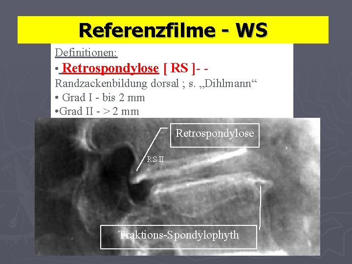 Referenzfilme - WS Definitionen: • Retrospondylose [ RS ]- Randzackenbildung dorsal ; s. „Dihlmann“