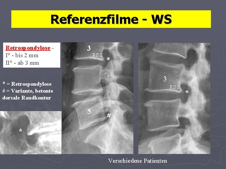 Referenzfilme - WS Retrospondylose I° - bis 2 mm II° - ab 3 mm
