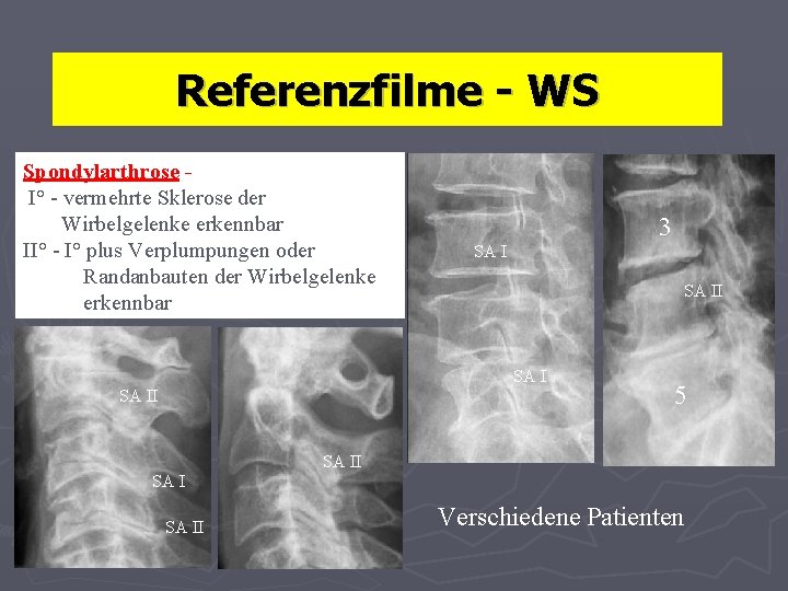 Referenzfilme - WS Spondylarthrose I° - vermehrte Sklerose der Wirbelgelenke erkennbar II° - I°