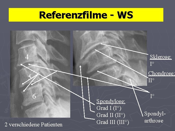 Referenzfilme - WS 4 Sklerose: I° Chondrose: II° 5 6 2 verschiedene Patienten Spondylose: