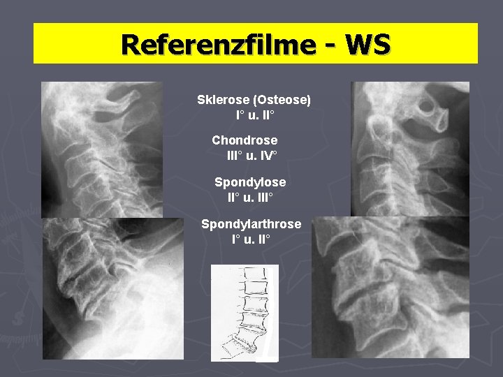 Referenzfilme - WS Sklerose (Osteose) I° u. II° Chondrose III° u. IV° Spondylose II°