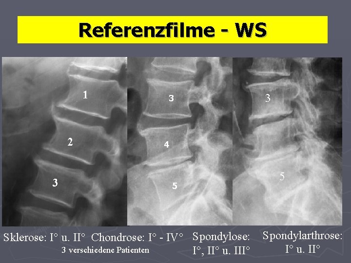 Referenzfilme - WS 1 2 3 3 3 4 5 Sklerose: I° u. II°